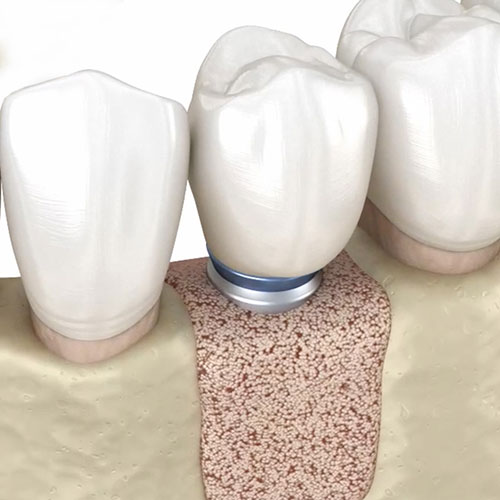 Graphic of a jaw bone with bone grafting material for dental implants