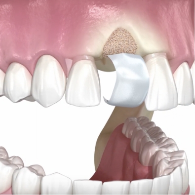 bone grafting example