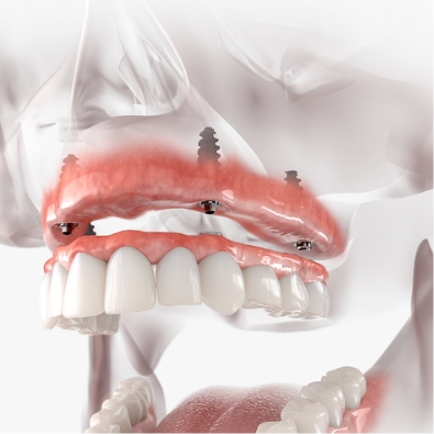 dental implants in a jaw