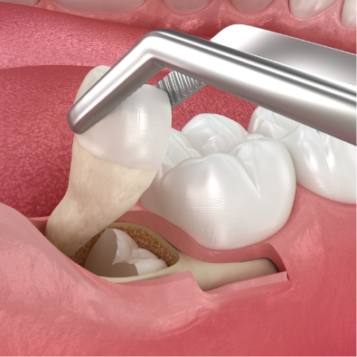wisdom tooth being removed